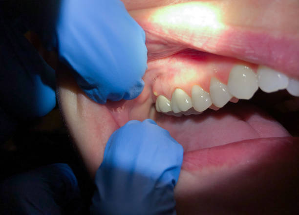 Best Emergency Gum Pain Relief  in Parachute, CO